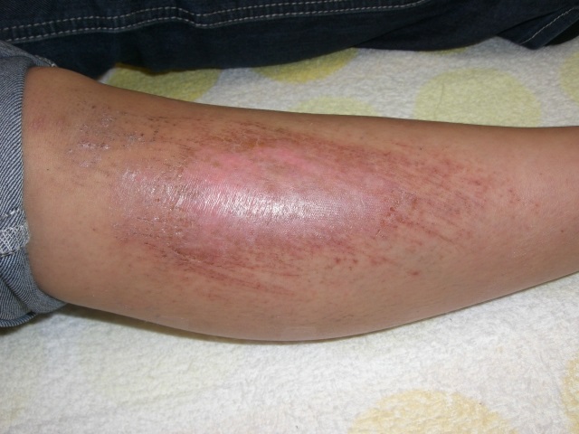 擦り傷 (かすりきず, こすりきず, すりきず) JapaneseEnglish Dictionary JapaneseClass.jp