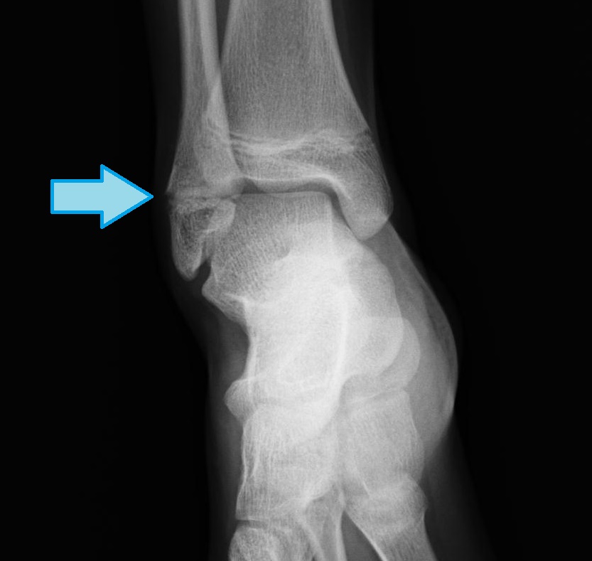 子供の足首の捻挫は骨端線損傷｜にしぼり整形外科｜茨城県笠間市
